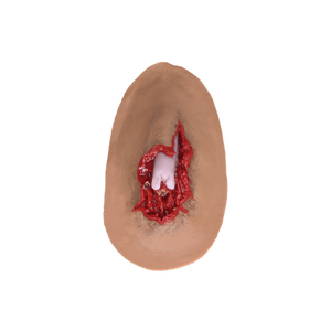 Laerdal Medical-Compound Fracture - Laerdal-MedTech-2