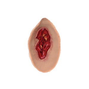 Laerdal Medical-Large Lesion - Laerdal-MedTech-2