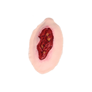 Laerdal Medical-Large Lesion - Laerdal-MedTech-1