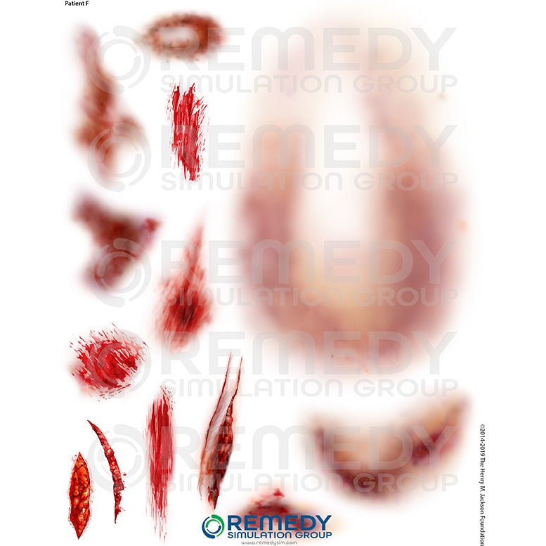 Wallcur-Moulage Tattoos - Patient E Scenario-MedTech-1