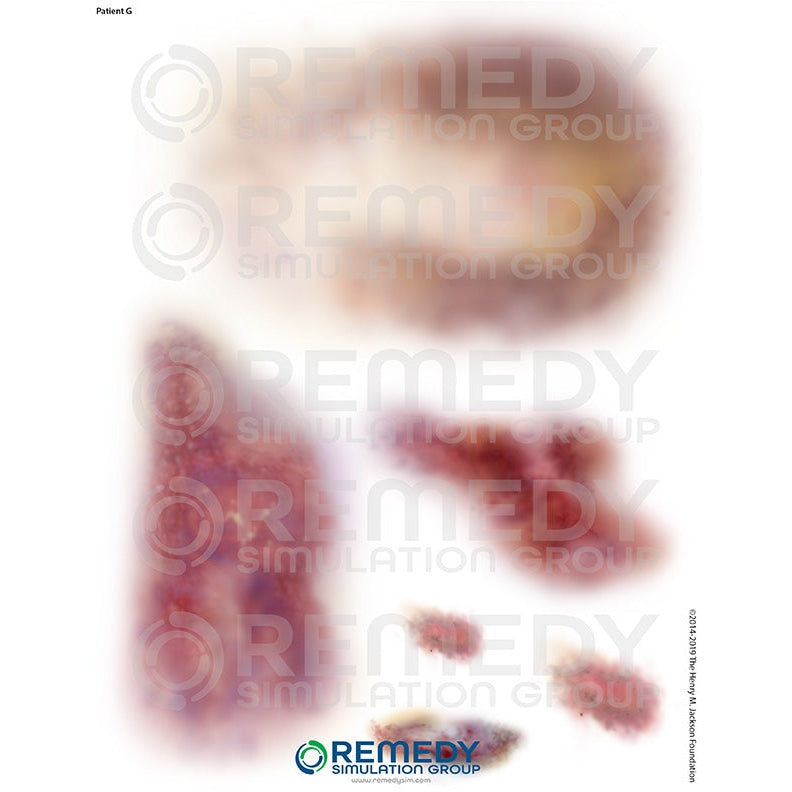 Wallcur-Moulage Tattoos - Patient G Scenario-MedTech-1