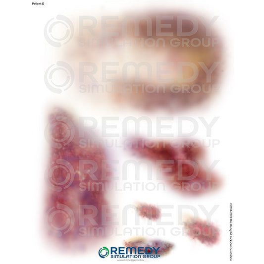 Wallcur-Moulage Tattoos - Patient G Scenario-MedTech-1