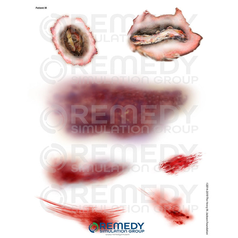 Wallcur-Moulage Tattoos - Patient M Scenario-MedTech-1