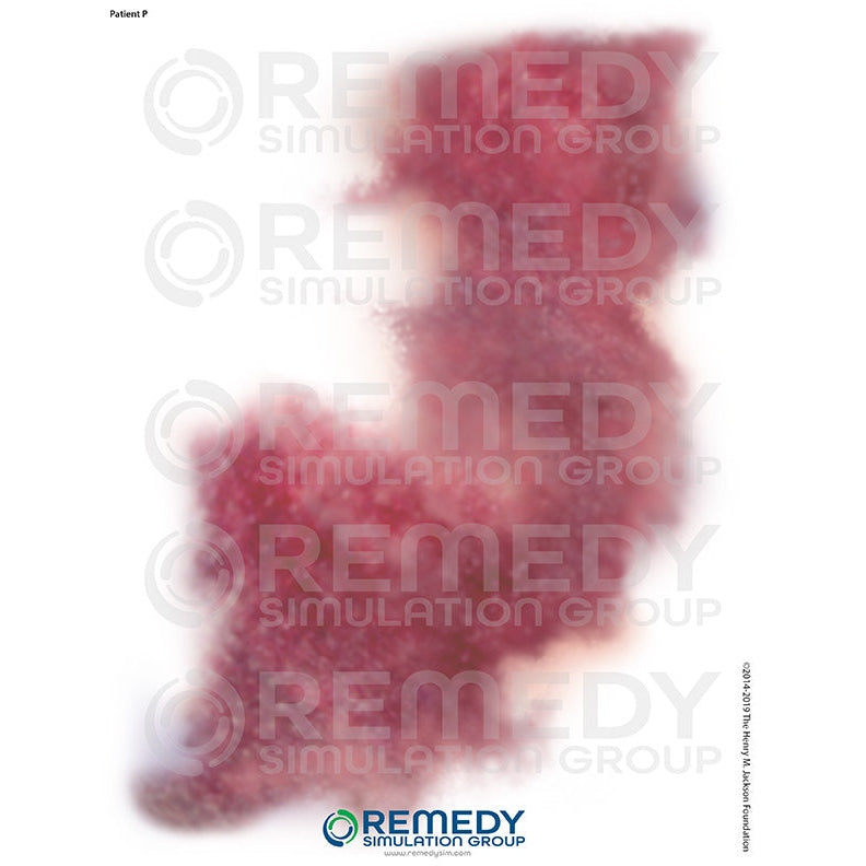 Wallcur-Moulage Tattoos - Patient P Scenario-MedTech-1