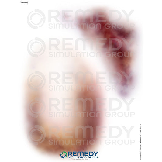 Wallcur-Moulage Tattoos - Patient Q Scenario-MedTech-1