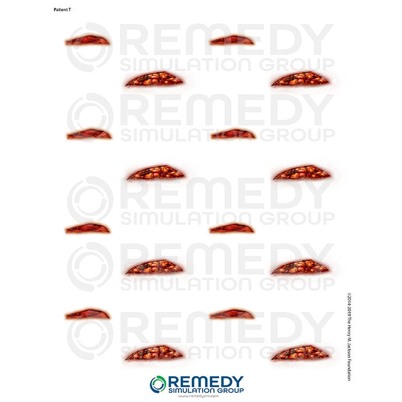 Wallcur-Moulage Tattoos - Patient T Scenario-MedTech-1
