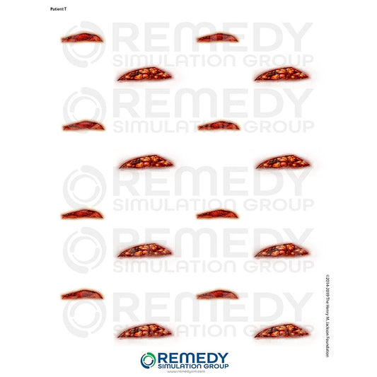 Wallcur-Moulage Tattoos - Patient T Scenario-MedTech-1