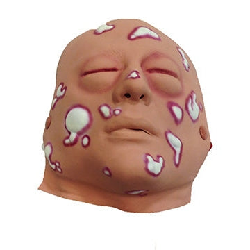 Nasco Healthcare-Mustard Gas Moulage-MedTech-1