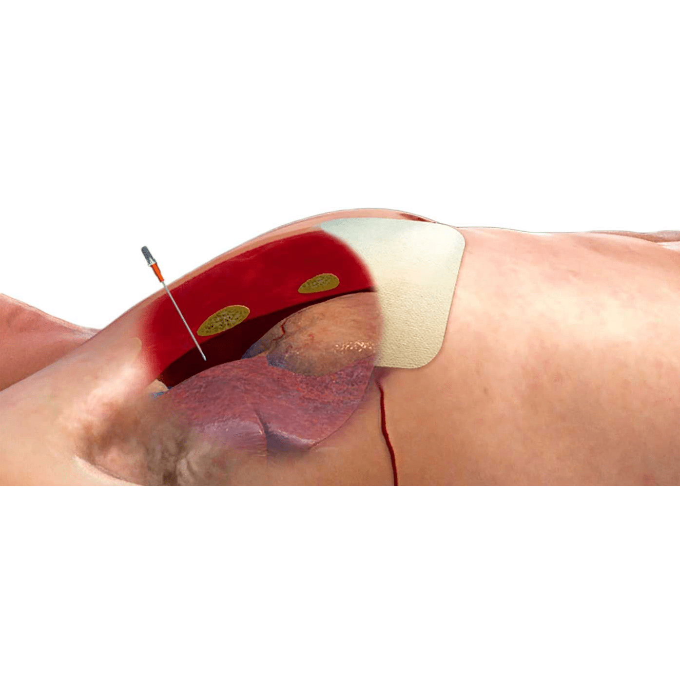 North American Rescue-North American Rescue ARS® for Decompression Needle, 14g x 3.25"-MedTech-3