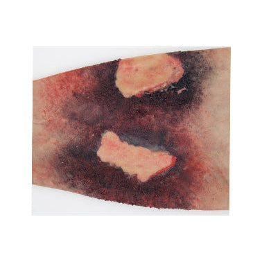 Safeguard Medical-SimBODIES Burns & Blisters Simulation Sleeves Kit-MedTech-3