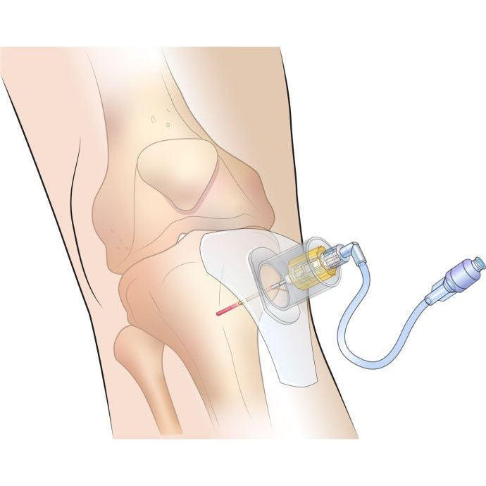  Sam Medical-SAM IO Stabilizer-MedTech-3