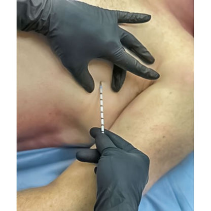 North American Rescue-Spear - Simplified Pneumothrax Emergency Air Release-MedTech-3